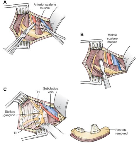 Steps of first rib removal. A, Sharp division of the anterior scalene... | Download Scientific ...