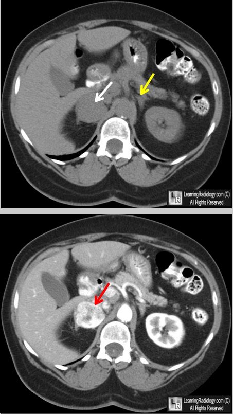 Pheochromocytoma Ct Scan