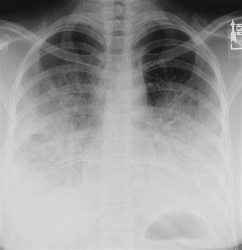 How serious is bilateral (double) pneumonia? - eHealthStar