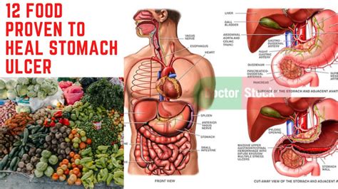 Discover 12 Powerful Foods That Can Heal Stomach Ulcers! - YouTube