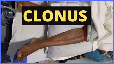 Clonus | Video demonstration & Explanation (in 3 mins) | Neurology | OSCE - YouTube