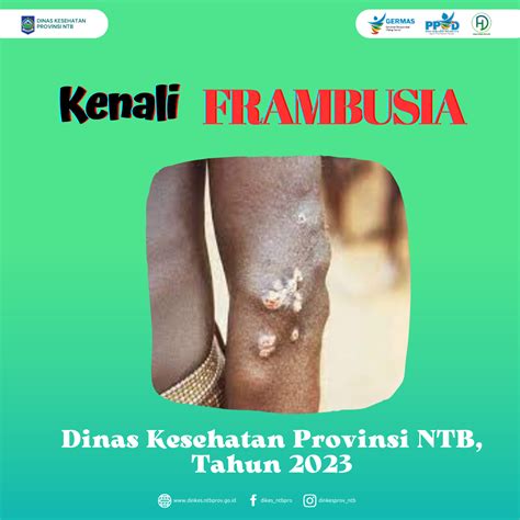 KENALI FRAMBUSIA - DINAS KESEHATAN PROVINSI NTB