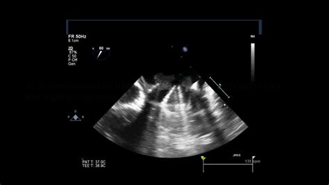 Mitral Valve Prosthesis