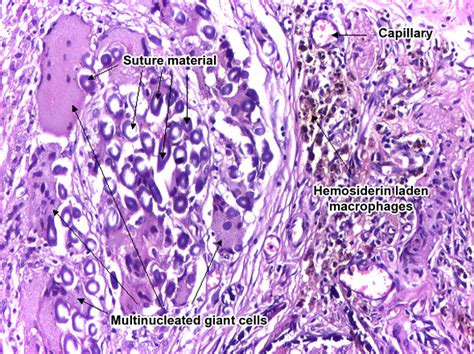 موقع الدكتور أحمد كلحى: صور باثولوجى - ﻿Patholgy Slides : Chronic ...