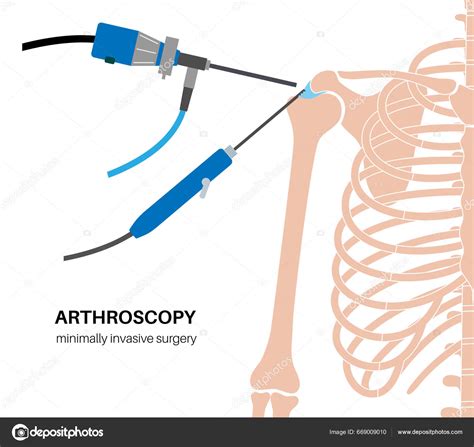 Shoulder Arthroscopy Procedure Rotator Cuff Tears Shoulder Joint ...