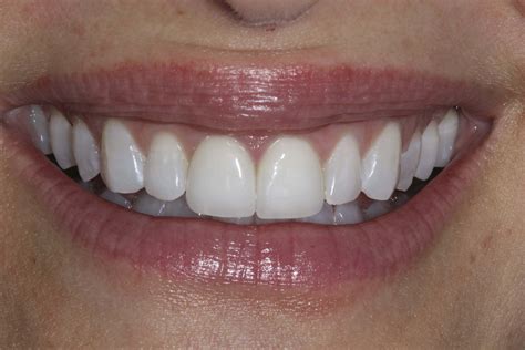 if-i-have-dental-caries-can-i-get-porcelain-veneers – Telegraph