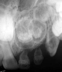 Periapical Radiograph Showing the Characteristically Ghost-like... | Download Scientific Diagram