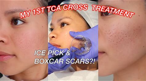 TCA CROSS FOR ACNE SCARS l Ice pick & Boxcar scars on Asian Skin - YouTube