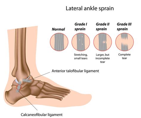 Ankle Sprain Grades