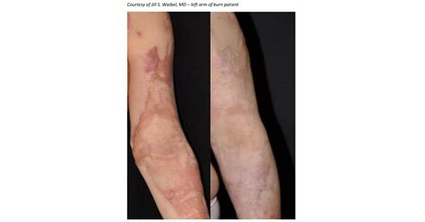 Early Treatment Is Revolutionizing Outcome Of Burn Scars