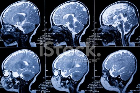 Baby Mri Brain Scan:Leukodystrophy Illness And Developmental Ano Stock ...