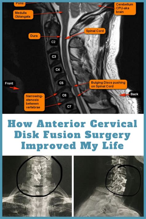 3 level cervical fusion recovery time - Ai Asbury