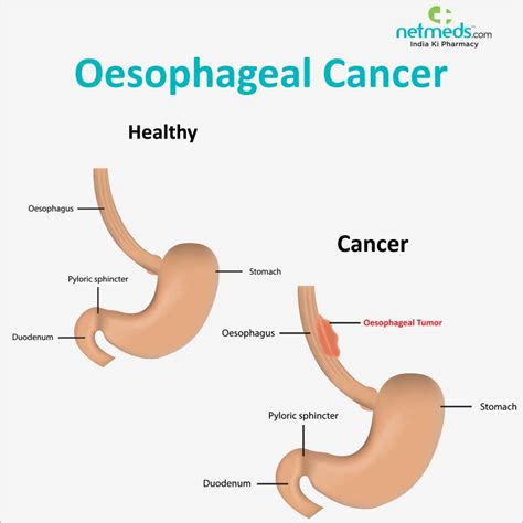 Oesophagus Cancer