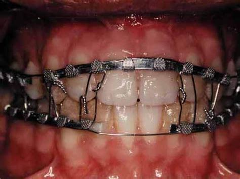 Maxillary Fracture - Fracture Treatment