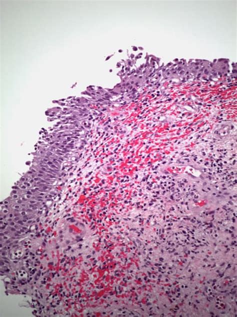 Pathology Outlines - Hemorrhagic cystitis