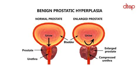 Benign Prostatic Hyperplasia Patofisiologi Diagnosis | Porn Sex Picture