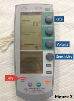 Transvenous Pacemaker Placement - Part 1: The Walkthrough — Taming the SRU