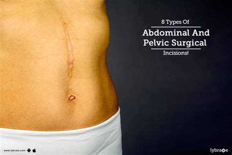 8 Types Of Abdominal And Pelvic Surgical Incisions! - By Dr. Ajay Gupta | Lybrate