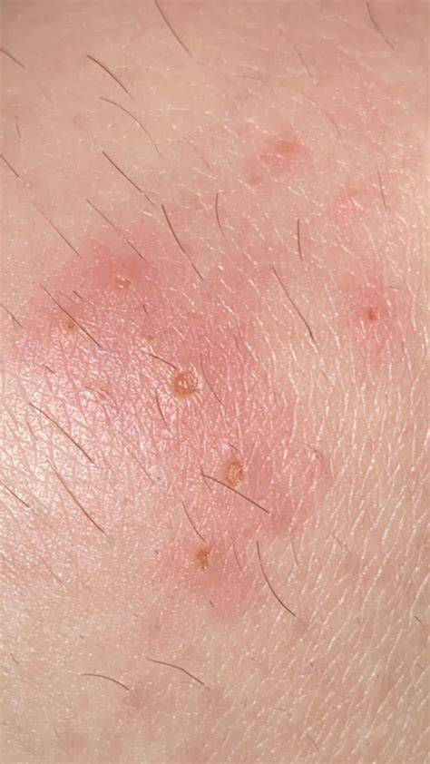 Is This a Yellow Sac Spider Bite? : r/medical_advice