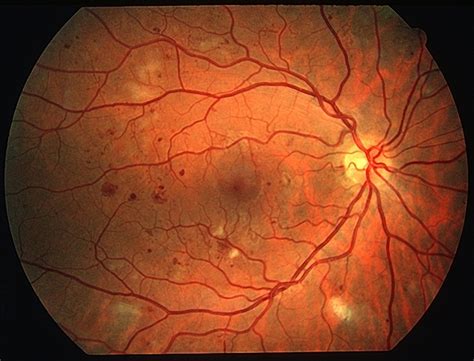 Diabetic Retinopathy – Retina Group of New England