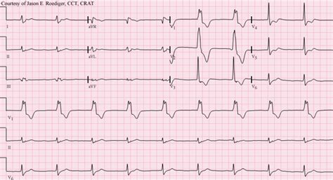 Idioventricular Rhythm Signs And Symptoms Factory Sale | www.jkuat.ac.ke