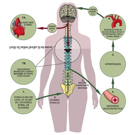 Craig Hospital | Information | Spinal Cord Injury Zone!