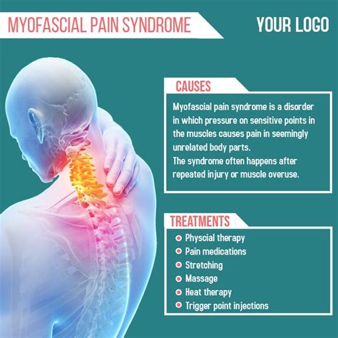 Myofascial Pain Syndrome