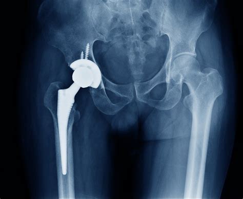 Hip replacement | Know everything about it | Ayushman Hospital and ...