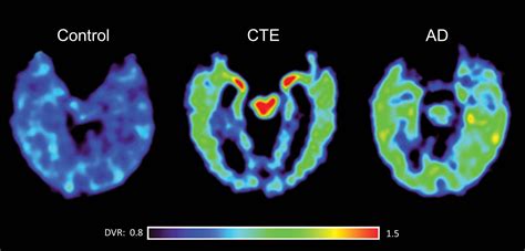 Cte Brain Disease : Aaron Hernandez S Brain Was Severely Afflicted By ...