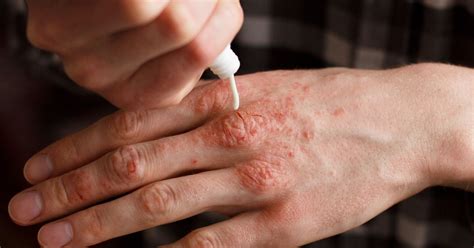 Palmoplantar Psoriasis: What Is It and How Do You Treat It?