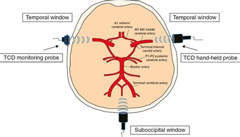 Sonothrombolysis | Neupsy Key