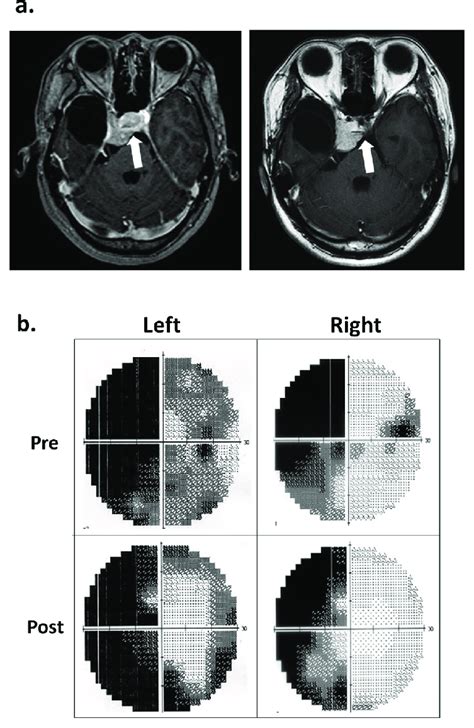 A 39 years old female with a residual right sphenoid ridge meningioma... | Download Scientific ...