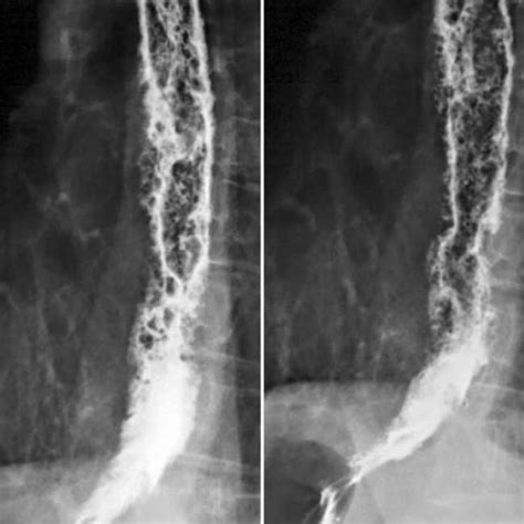 Esophageal Candidiasis Barium Swallow