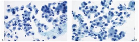 Neuroendocrine Tumors of the Pancreas | Basicmedical Key