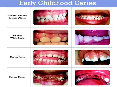 treating cavities in baby teeth - Maryland Falk