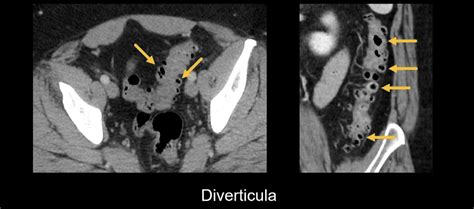 Abdominal CT: diverticulitis • LITFL • Radiology Library