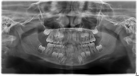 Mesiodens / Rontgen Panorama Bild Mesiodens Obere Linke Schneidezahn Stockfotografie Alamy : The ...