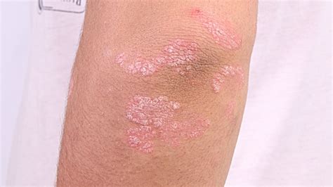 Psoriasis in Children: Symptoms, Treatments, and More