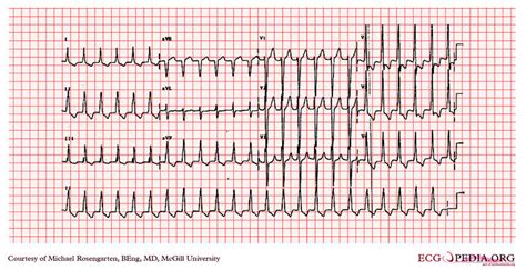 Atrial flutter EKG examples - wikidoc