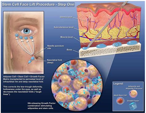 Adipose Stem Cell Therapies are Revolutionizing Plastic Surgery, and ...