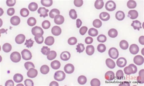 Acanthocytes - LearnHaem | Haematology Made Simple