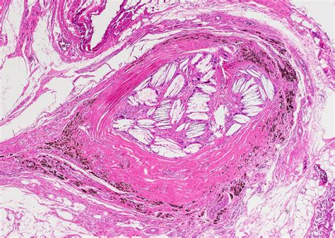 Thyroglossal Duct Cyst Histology