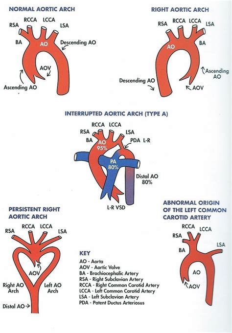 Right sided aortic arch Subclavian Artery, Carotid Artery, Coarctation Of The Aorta, Heart ...