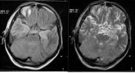 Presenting With Status Epilepticus That Neurosyphilis: Case Report | Demir | Journal of ...