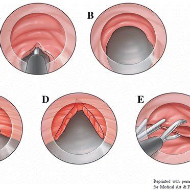 Per oral endoscopic pyloromyotomy procedure, in-scope view. A ...