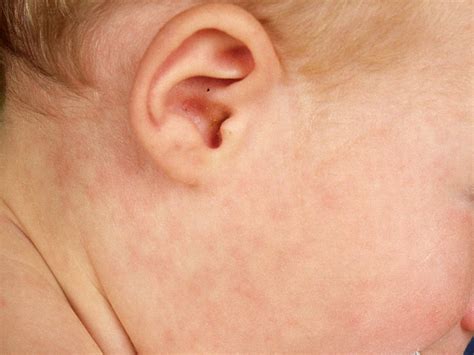 Exanthema subitum (roseola infantum, zesde ziekte)