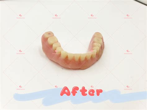 Professional Denture & Partial Repair | Etsy