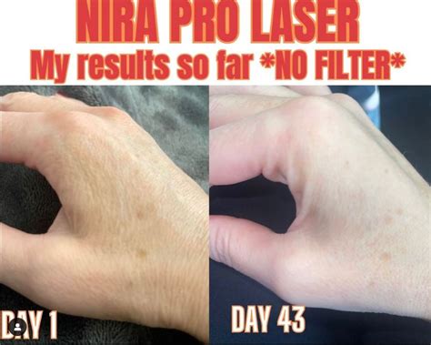 My NIRA Pro Laser Results: Before And After Pictures! (+25% Off Code ...