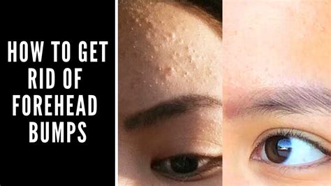 How to Get Rid of Forehead Bumps - YouTube