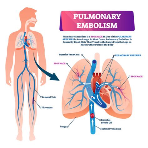 Pulmonary Embolism - DrCRaghu